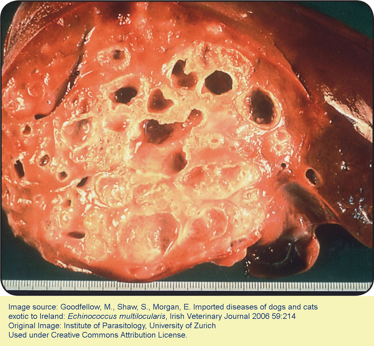 alveolar-hydatid-human-liver-2021.jpg