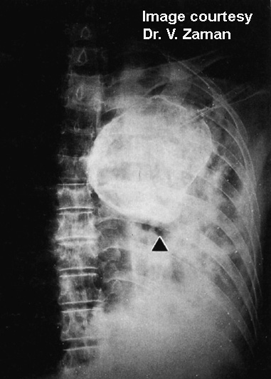 hydatid-human-lung-radiograph-2021.jpg