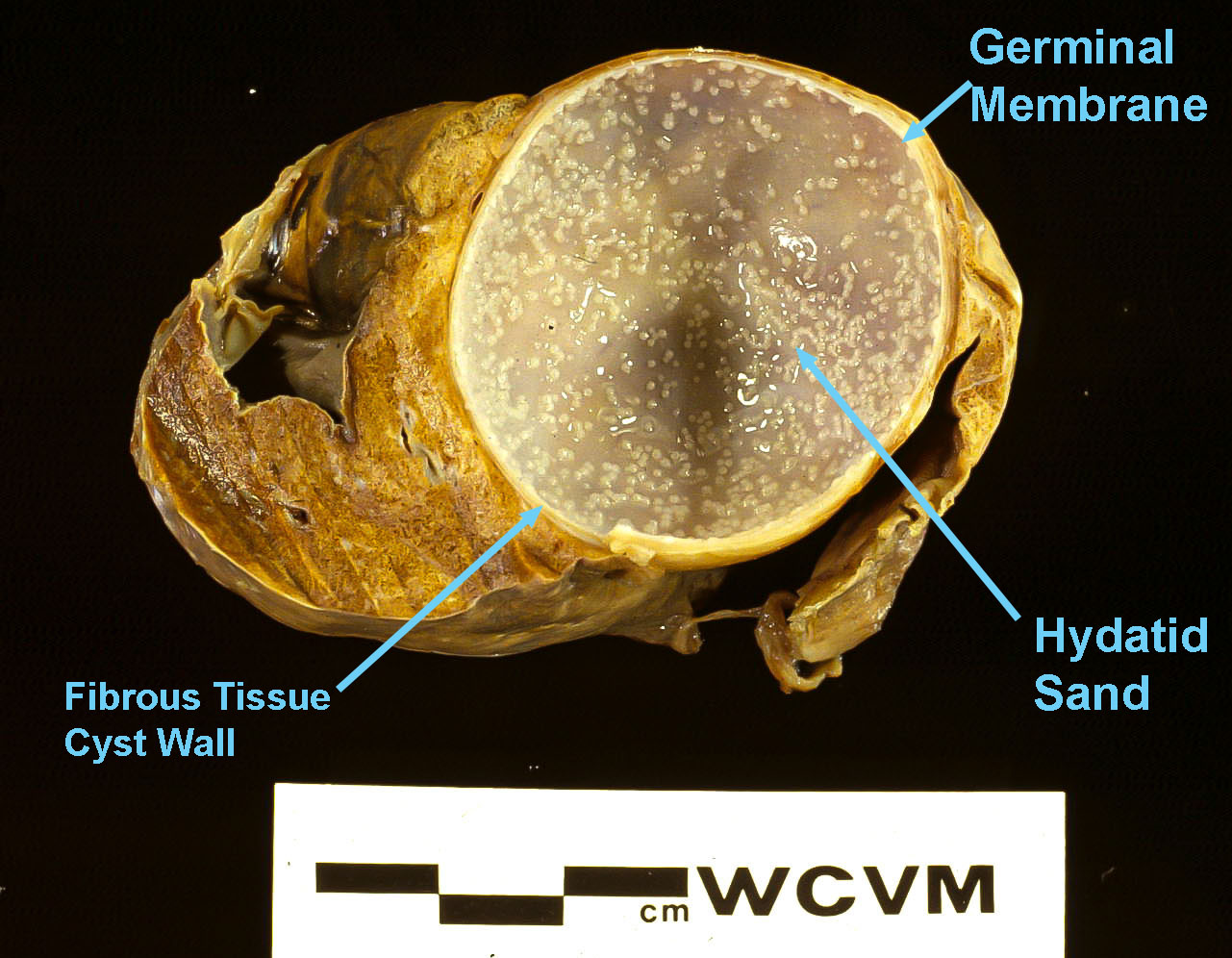 Echinococcus Granulosus Hydatid Sand