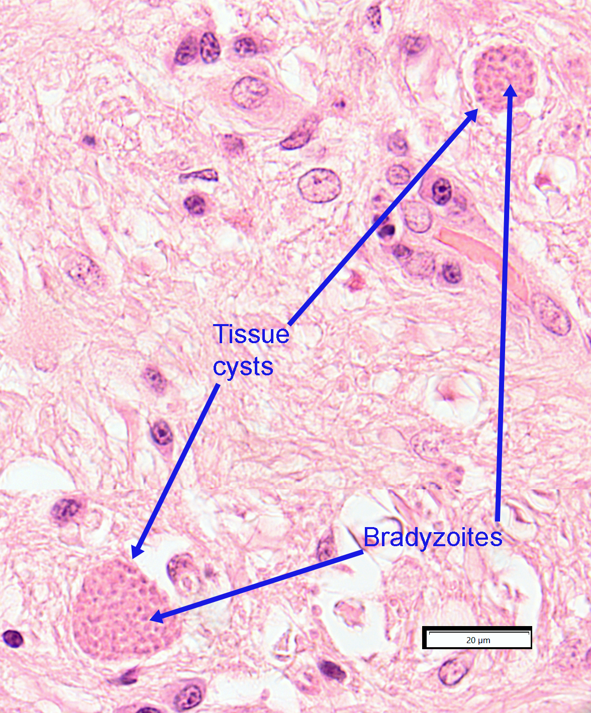 toxoplasmosis gondii cysts