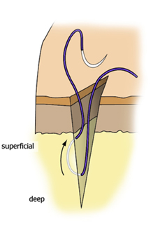 buried knot suture