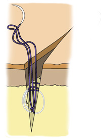 buried knot suture