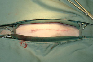 Completed Incision