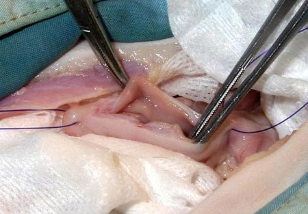 Gastrotomy Suture