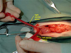 Exteriorizing Uterus