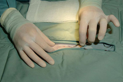 Subcutaneous incision 